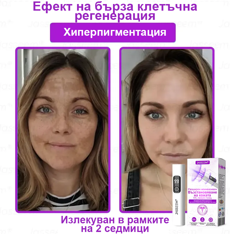 𝐉𝐚𝐬𝐬𝐞𝐞𝐦® Усъвършенствана неинвазивна CO₂ лазерна писалка за възстановяване на кожата 💕 (Нежно премахва брадавици, родилни белези, старчески петна и кожни образувания - без болка, без притеснения!)